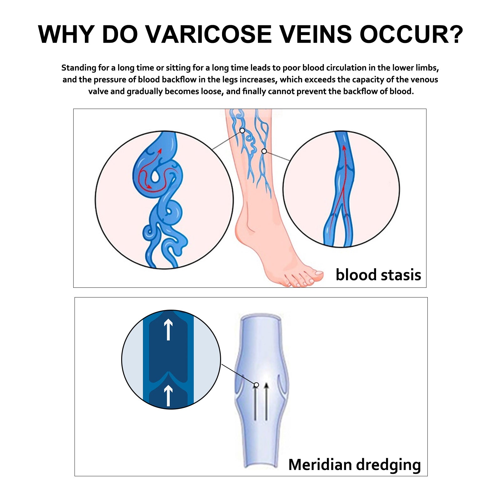 Leg Repair Cream Relieves Leg Discomfort Massage Leg Repair Cream For Raised Veins