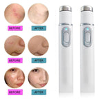 Eraser Blue Light Therapy Wrinkle Acne Laser Pen Soft Scar Removal
