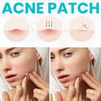 Acne Patch, Repair Facial Acne Invisible Concealer Hydrocolloid Patch