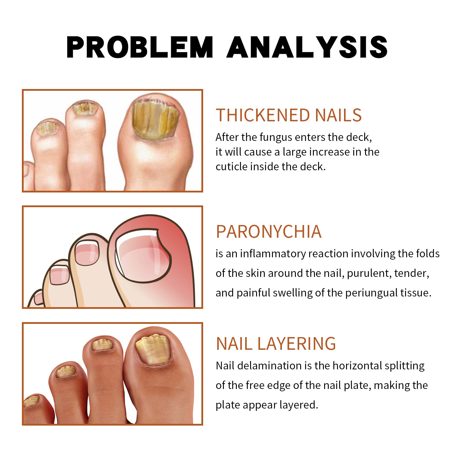 Anti-Nail Groove Relief Oil, Repair Inlaid Nails Gray Nails And Soft Thickening Nail Brightening Nails Care Oil