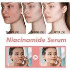 Nicotinamide Essence Tights And Moisturizes Pores, Lighens Acne Marks And Spots, Moisturizes And Brighens Skin