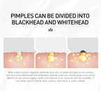 AUQUEST Salicylic Acid Acne Face Cream Pore Blackhead Removal Oil Control Niacinamide Facial Cream Skin Care