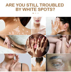 Effectively Remove Vitiligo Ointment Ringworm White Spot Removal Skin Vitiligo Eliminate Vitiligo Skin Care