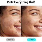 262/360Pcs Cute Colorful Pimple Patches Acne Treatment Stickers Invisible Acne Cover Face Spot Pimple Patch Skin Care Makeup