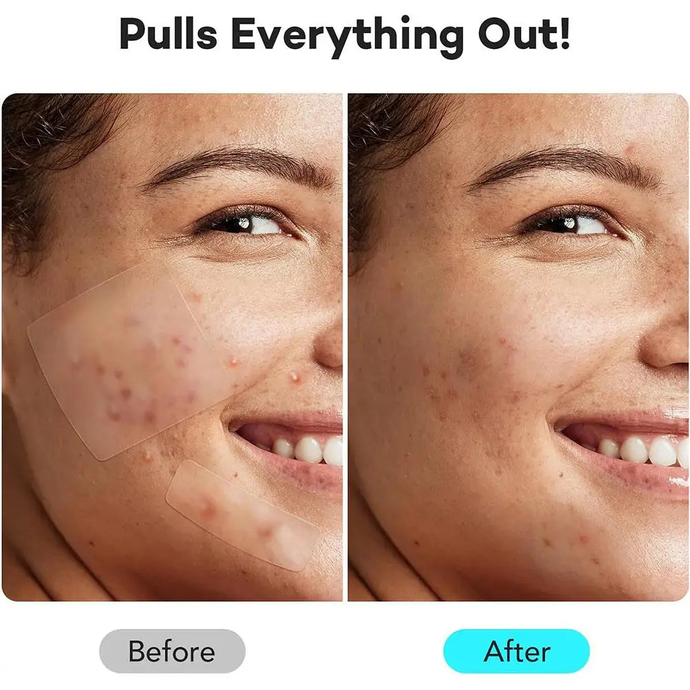 262/360Pcs Cute Colorful Pimple Patches Acne Treatment Stickers Invisible Acne Cover Face Spot Pimple Patch Skin Care Makeup