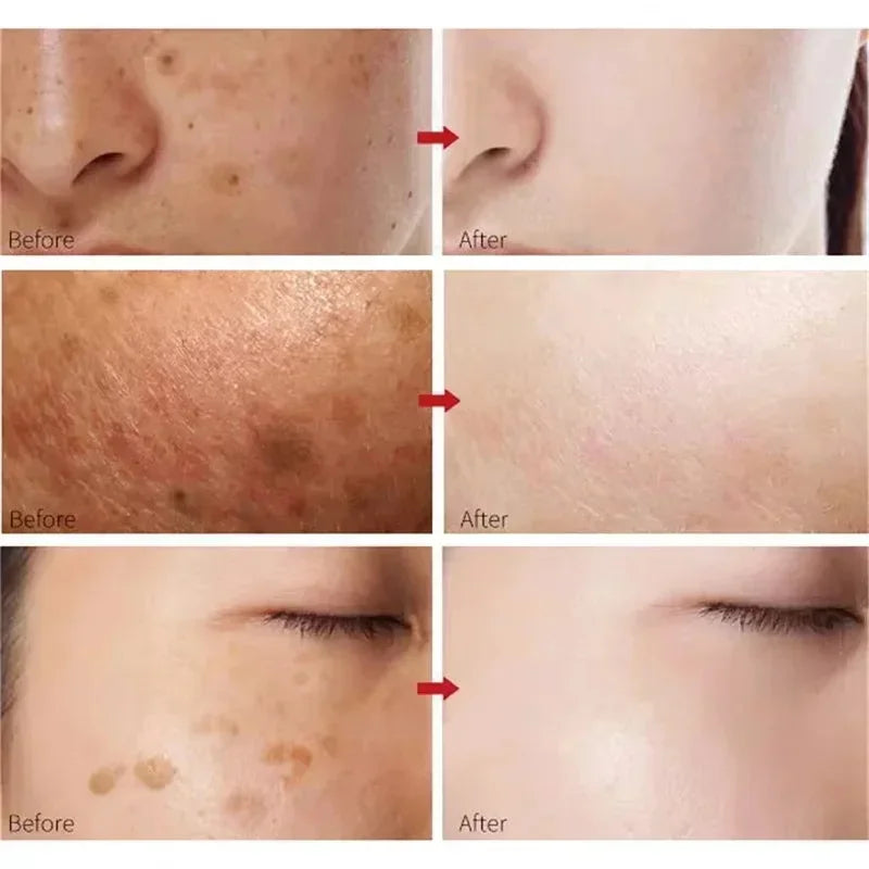 Amino Acid Freckle Whitening Cream Fade Pigmentation Melasma Dark Spots Corrector Repair Cream Korean Skin Care