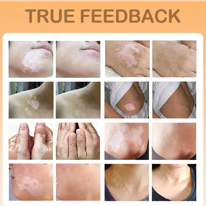 Effectively Remove Vitiligo Ointment Ringworm White Spot Removal Skin Vitiligo Eliminate Vitiligo Skin Care