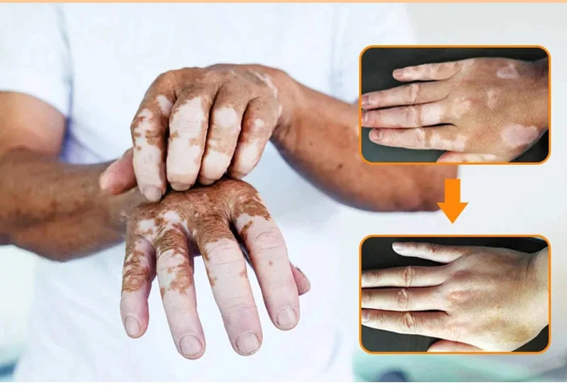 Effectively Remove Vitiligo Ointment Ringworm White Spot Removal Skin Vitiligo Eliminate Vitiligo Skin Care