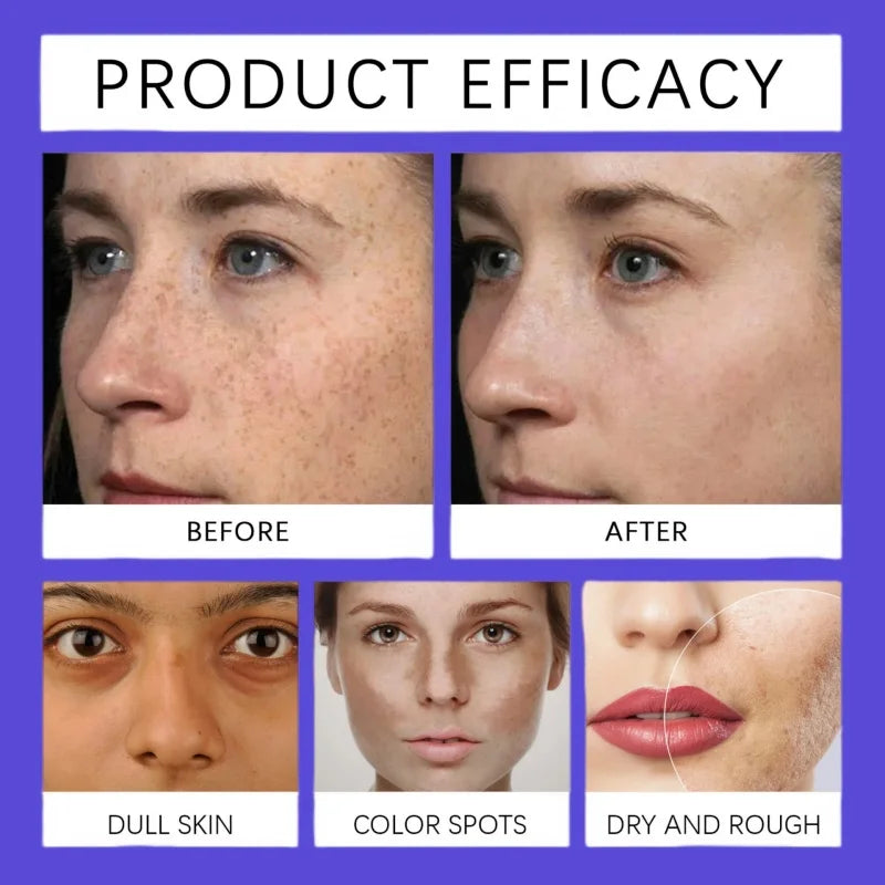 Amino Acid Freckle Whitening Cream Fade Pigmentation Melasma Dark Spots Corrector Repair Cream Korean Skin Care