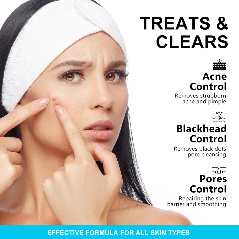 AUQUEST Salicylic Acid Acne Face Cream Pore Blackhead Removal Oil Control Niacinamide Facial Cream Skin Care