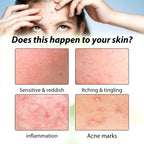 Acne Face Cream Pimple Treatment Oil Control Repair Redness Remove Blackhead Smooth Hydrating Moisturizing Pore Shrinking Serum