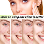 Acne Face Cream Pimple Treatment Oil Control Repair Redness Remove Blackhead Smooth Hydrating Moisturizing Pore Shrinking Serum