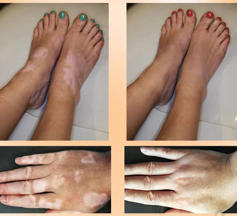 Effectively Remove Vitiligo Ointment Ringworm White Spot Removal Skin Vitiligo Eliminate Vitiligo Skin Care