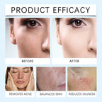Acne Cream,remove Dirt That Clogs Pores,balance Skin's Moisture To Maintain,Effectively Remove Acne On Facial Skin,50g