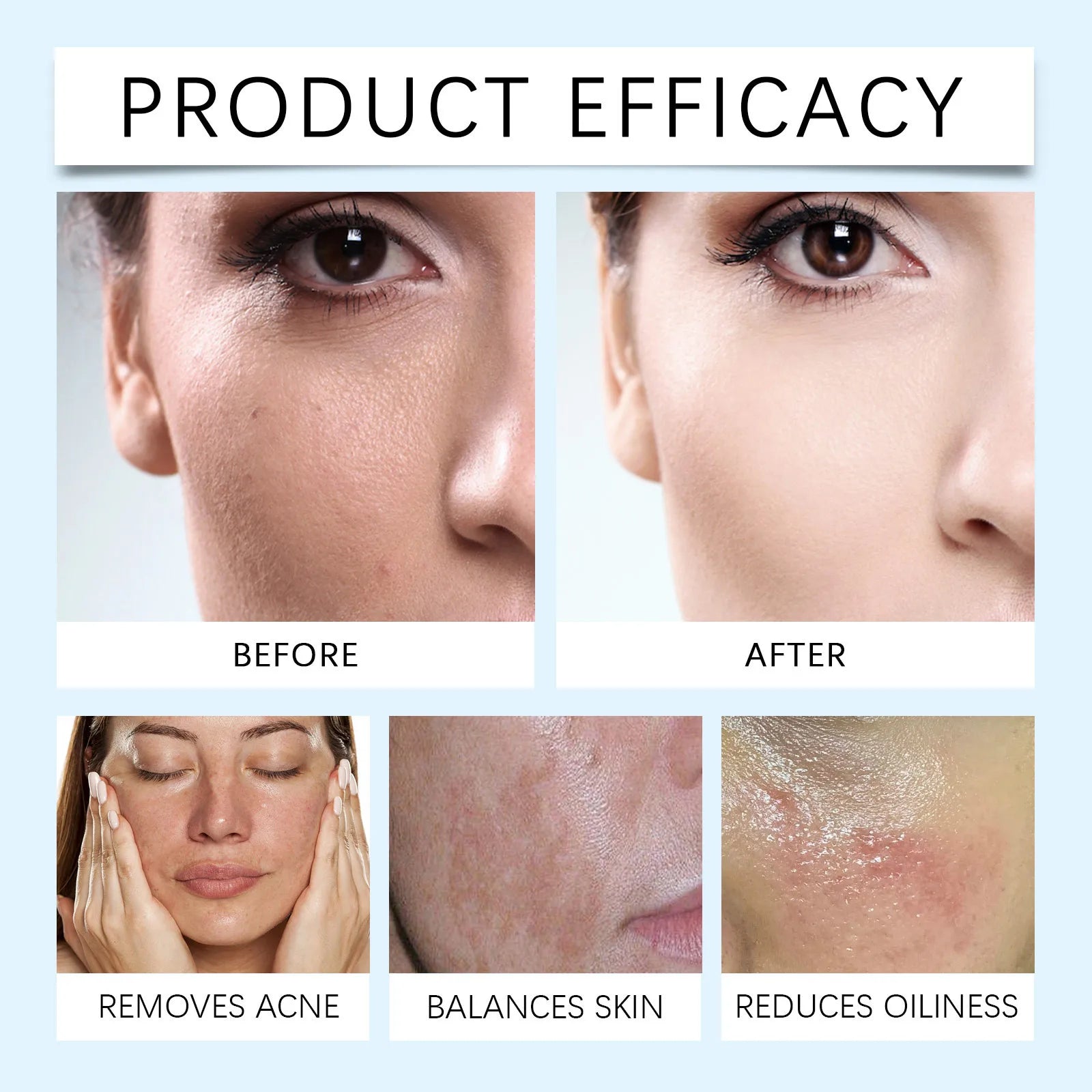 Acne Cream,remove Dirt That Clogs Pores,balance Skin's Moisture To Maintain,Effectively Remove Acne On Facial Skin,50g