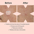100 Patches Bear Shape Pimple Patches Colorful Hydrocolloid Pimple Healing Sticker Cute Strong Absorption Zit Patches Face Care