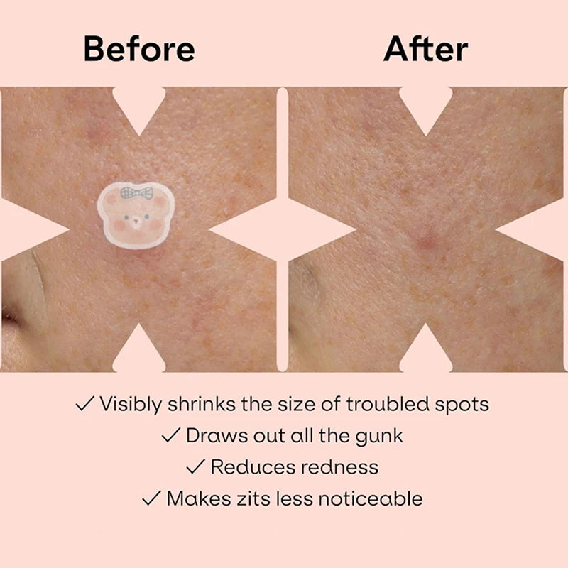 100 Patches Bear Shape Pimple Patches Colorful Hydrocolloid Pimple Healing Sticker Cute Strong Absorption Zit Patches Face Care