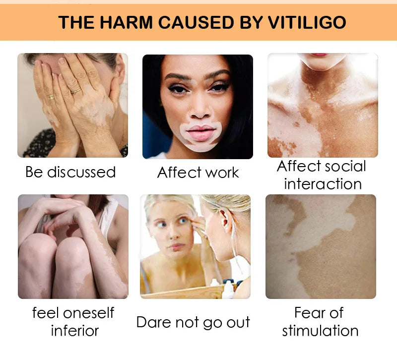 Effectively Remove Vitiligo Ointment Ringworm White Spot Removal Skin Vitiligo Eliminate Vitiligo Skin Care