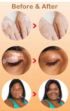 Effectively Remove Vitiligo Ointment Ringworm White Spot Removal Skin Vitiligo Eliminate Vitiligo Skin Care