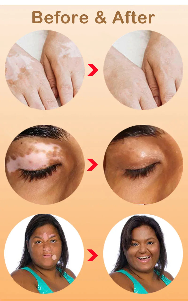 Effectively Remove Vitiligo Ointment Ringworm White Spot Removal Skin Vitiligo Eliminate Vitiligo Skin Care