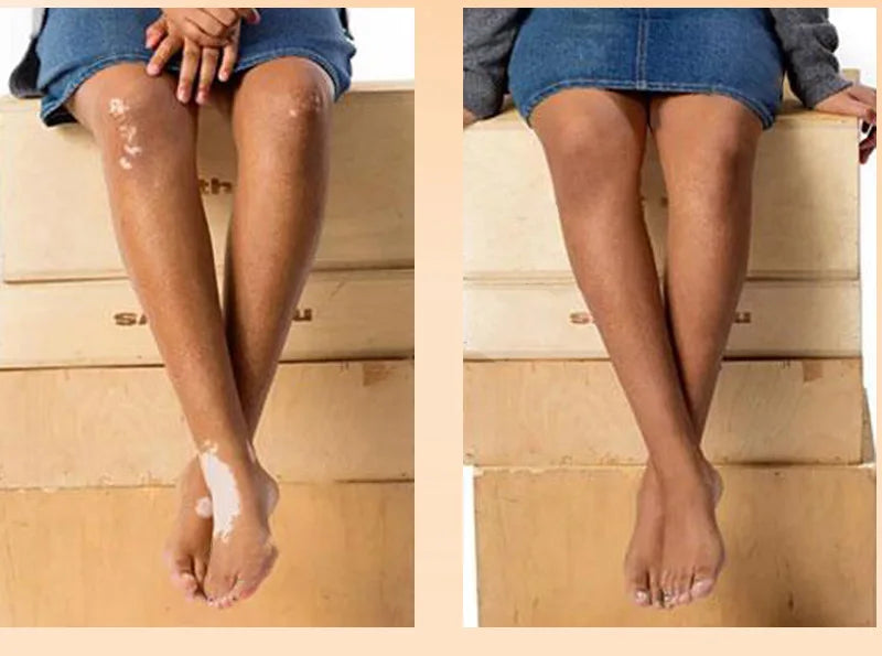 Effectively Remove Vitiligo Ointment Ringworm White Spot Removal Skin Vitiligo Eliminate Vitiligo Skin Care