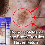 Amino Acid Freckle Whitening Cream Fade Pigmentation Melasma Dark Spots Corrector Repair Cream Korean Skin Care