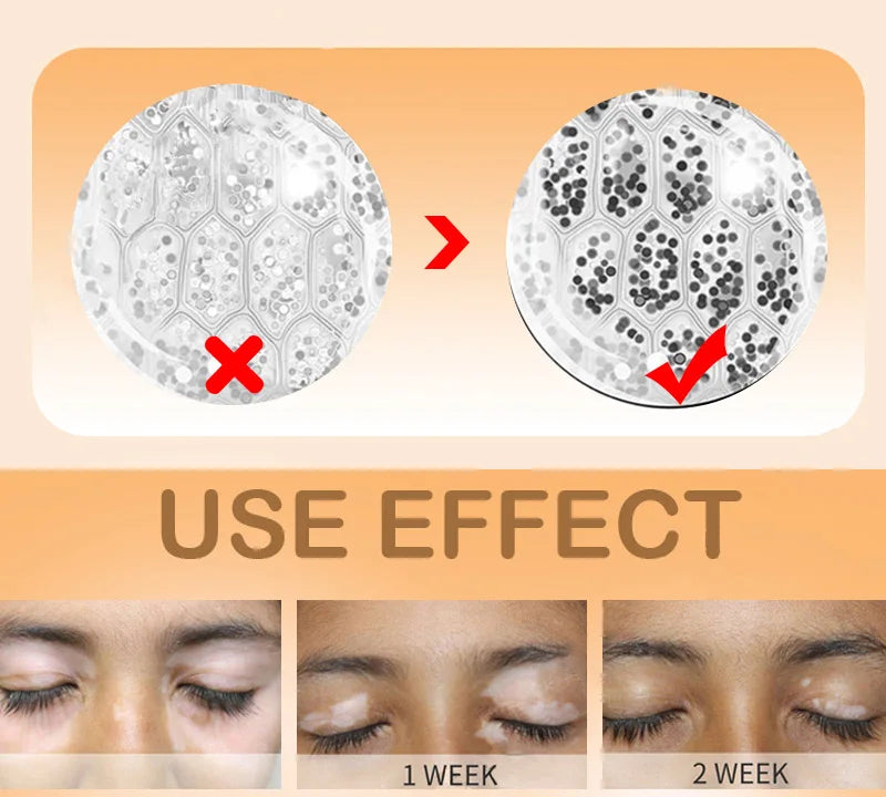 Effectively Remove Vitiligo Ointment Ringworm White Spot Removal Skin Vitiligo Eliminate Vitiligo Skin Care