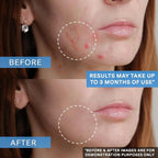 Adapalene Gel 0.1% Acne Treatment 1.6 Oz (45 G) | OTC Retinoid Acne Cream